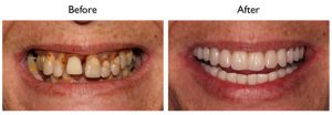 before:after all 4